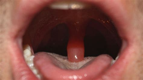 does your uvula touch your tongue|my uvula is touching tongue.